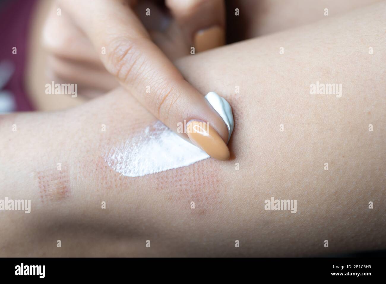 Marks after laser hair or scar removal from the skin. CO2 technique