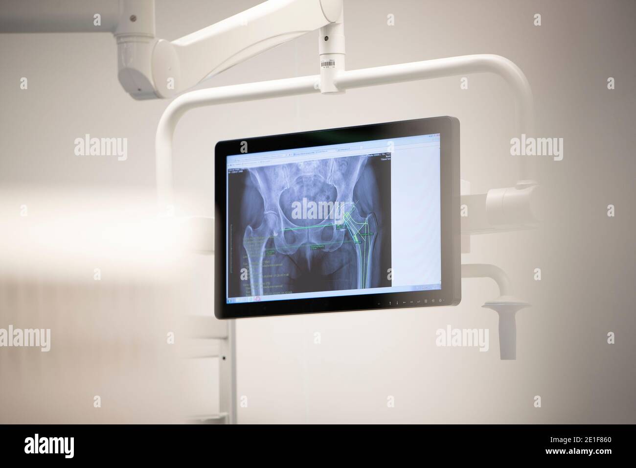 image of a hip x-ray on a screen in an operating theater Stock Photo