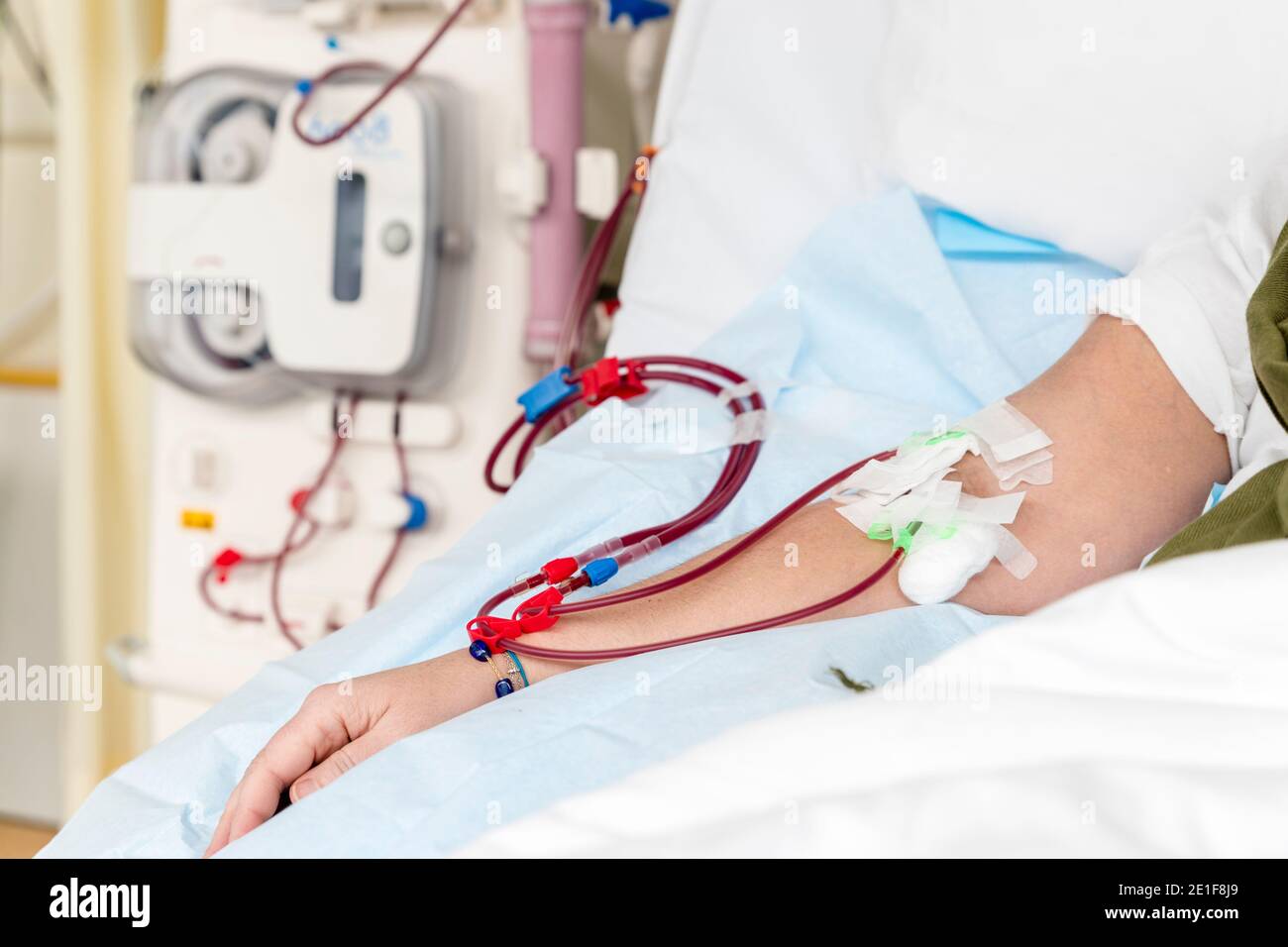 arm of a patient with a hemodialysis catheter during a treatment Stock