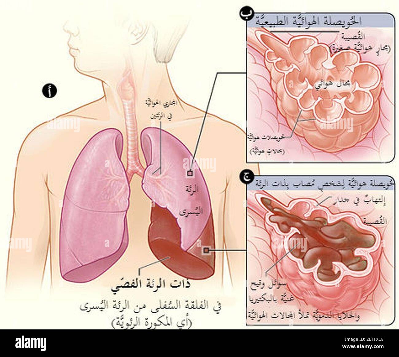 Lobar Pneumonia Illustrated Ar Stock Photo Alamy
