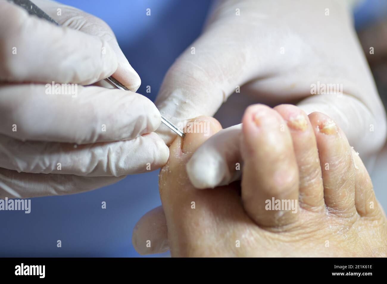 removing toenail fungus with a sterile podiatry tool Stock Photo