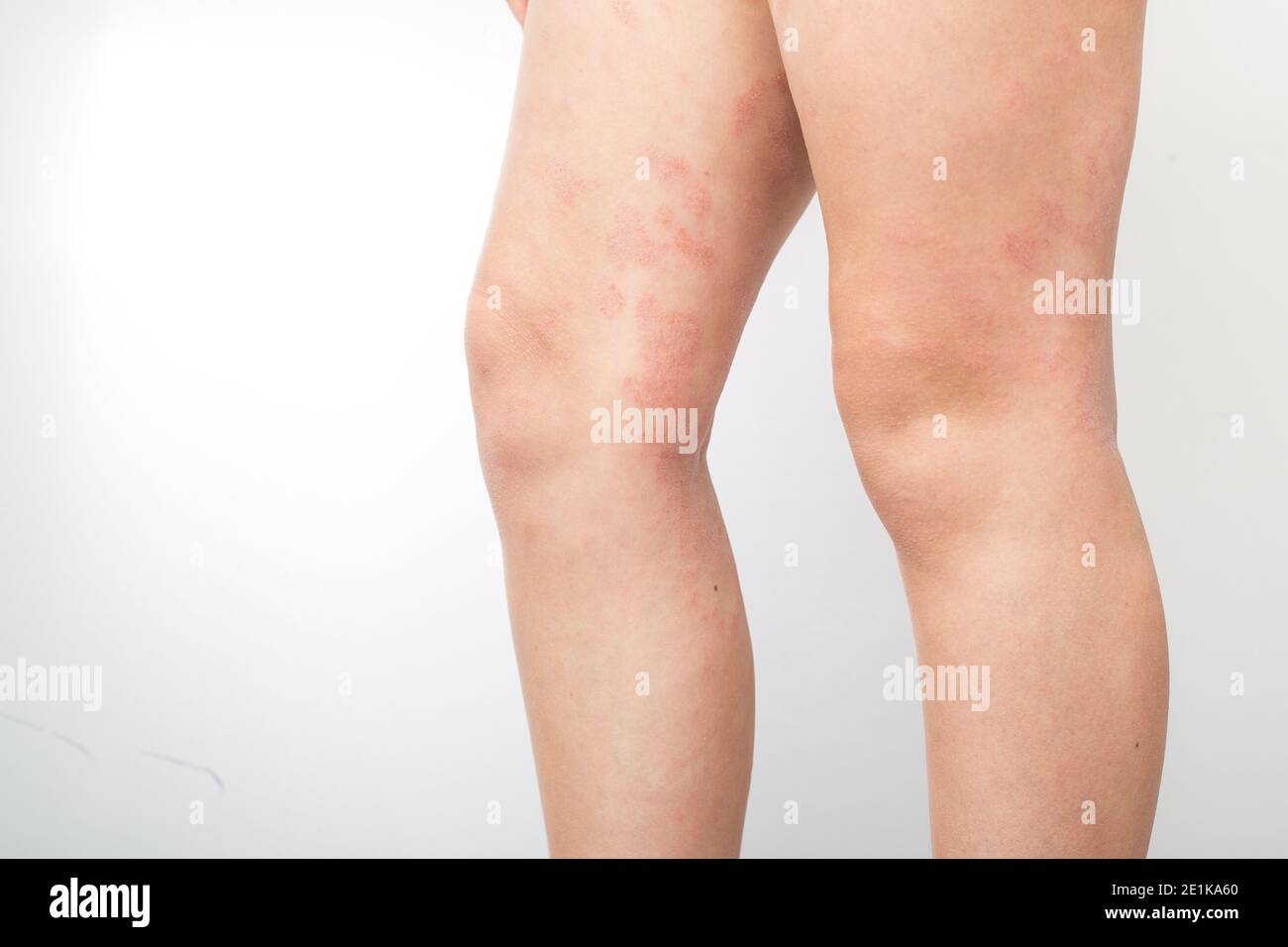 Acute atopic dermatitis on the feet of a child is a dermatological skin