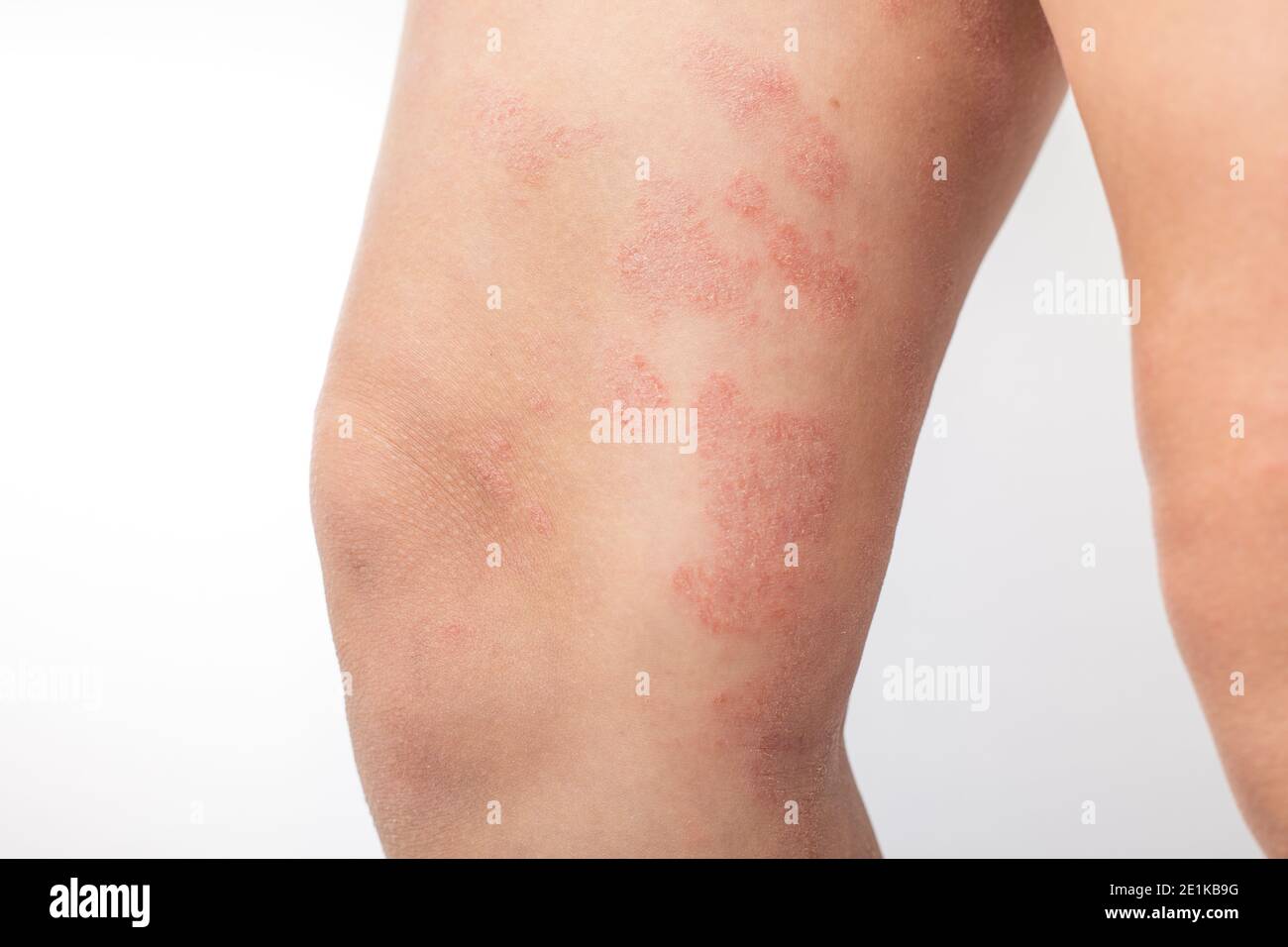 Severe atopic eczema on the legs of a child is a dermatological disease