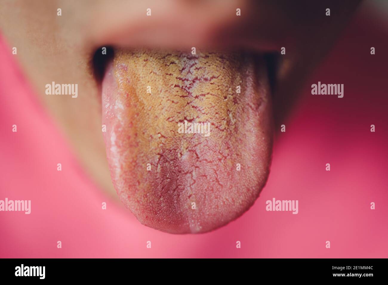 dirty-tongue-close-up-yellow-due-to-illness-stock-photo-alamy