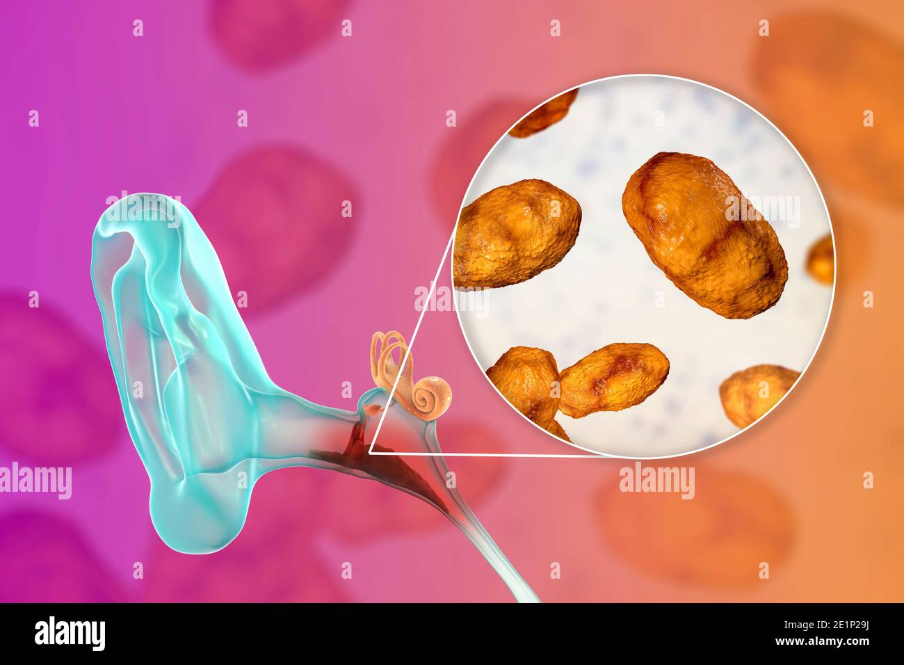 Otitis media ear infection, illustration Stock Photo Alamy