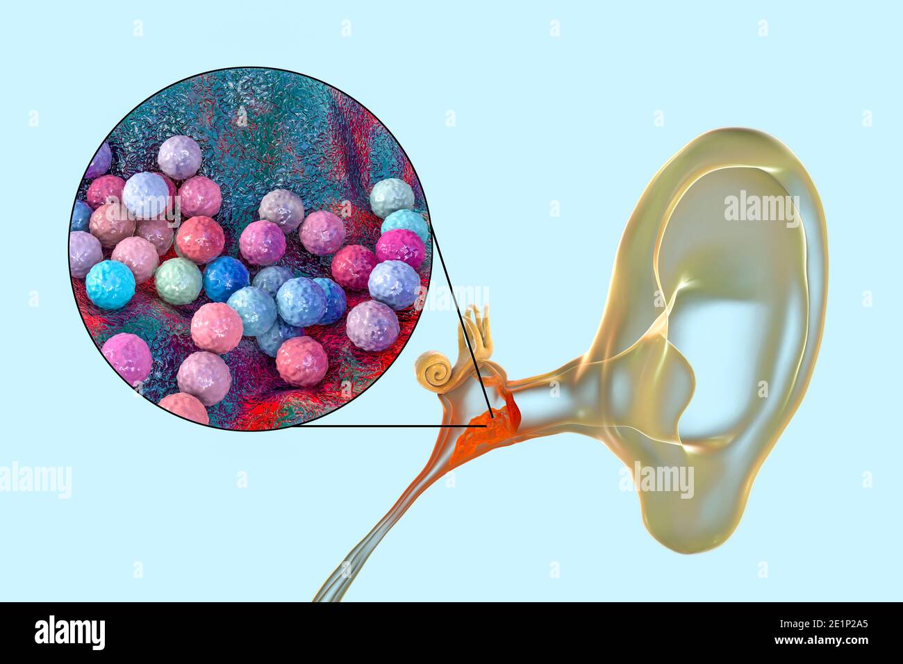 Otitis media ear infection, illustration Stock Photo Alamy