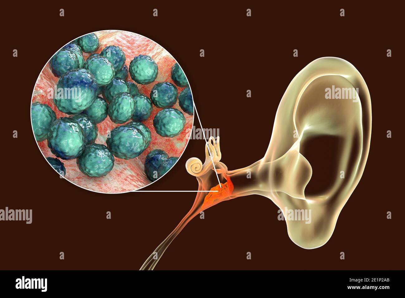 Otitis media ear infection, illustration Stock Photo Alamy
