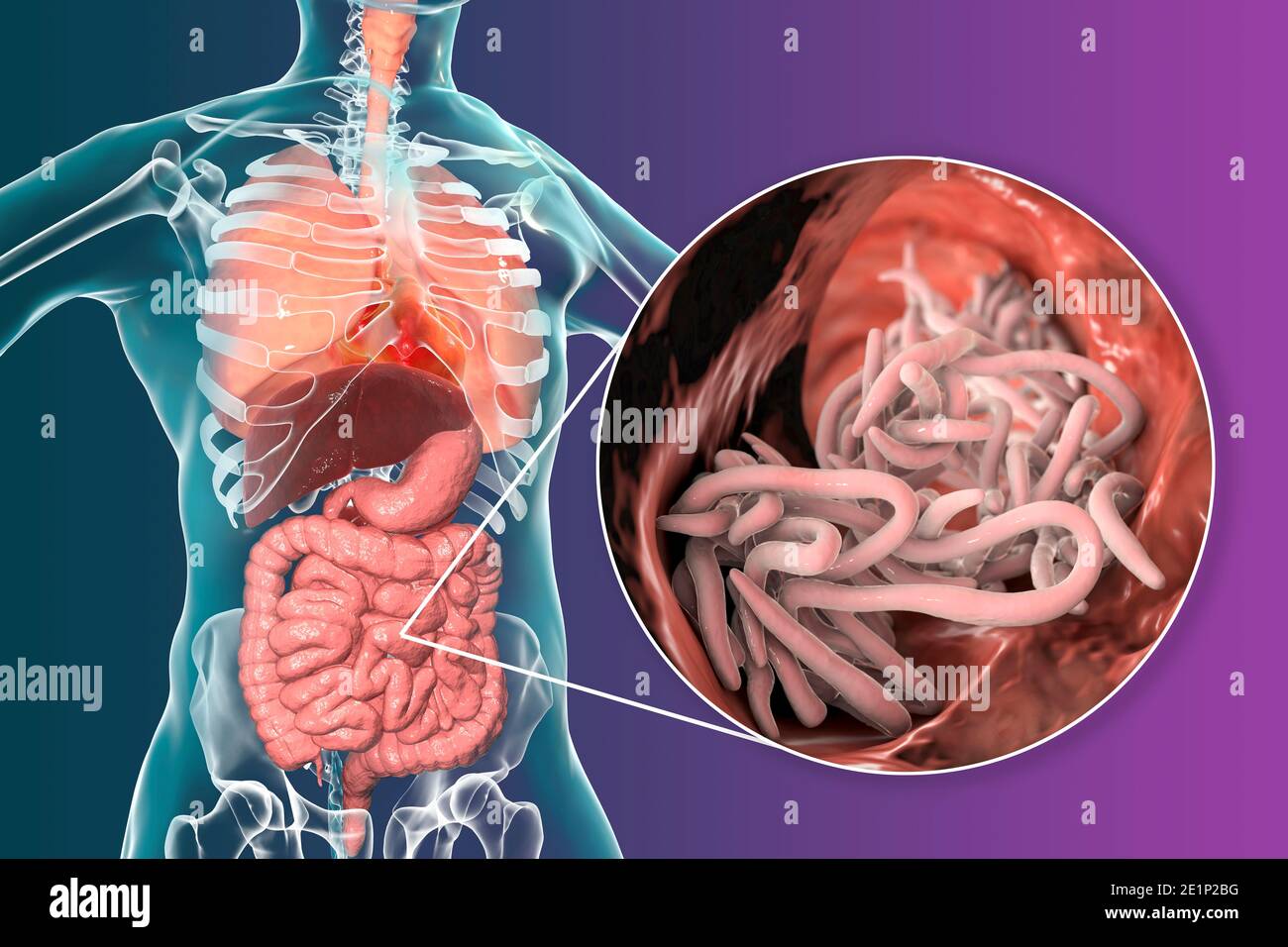 Round worms in human intestine, illustration Stock Photo