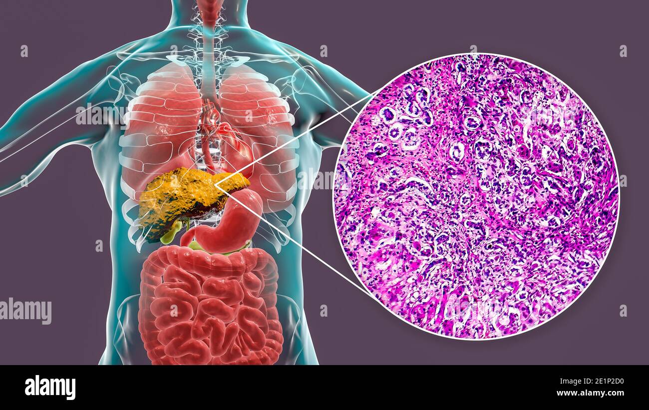 Liver Disease Cells High Resolution Stock Photography and Images Alamy