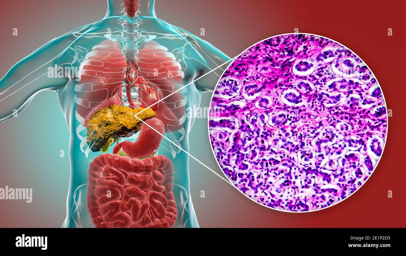 Histology liver cirrhosis hi-res stock photography and images - Alamy
