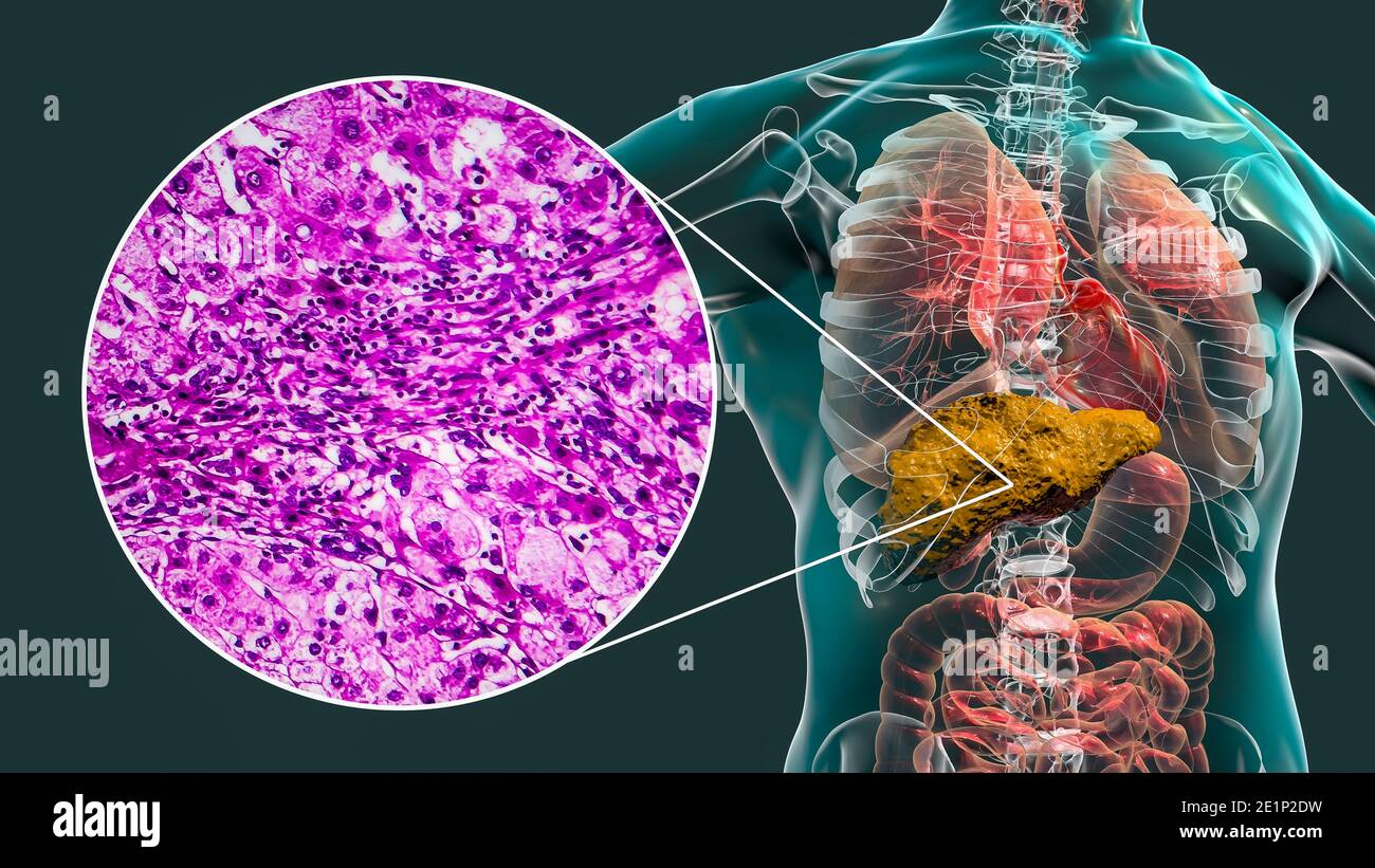Liver cirrhosis, illustration and light micrograph Stock Photo Alamy