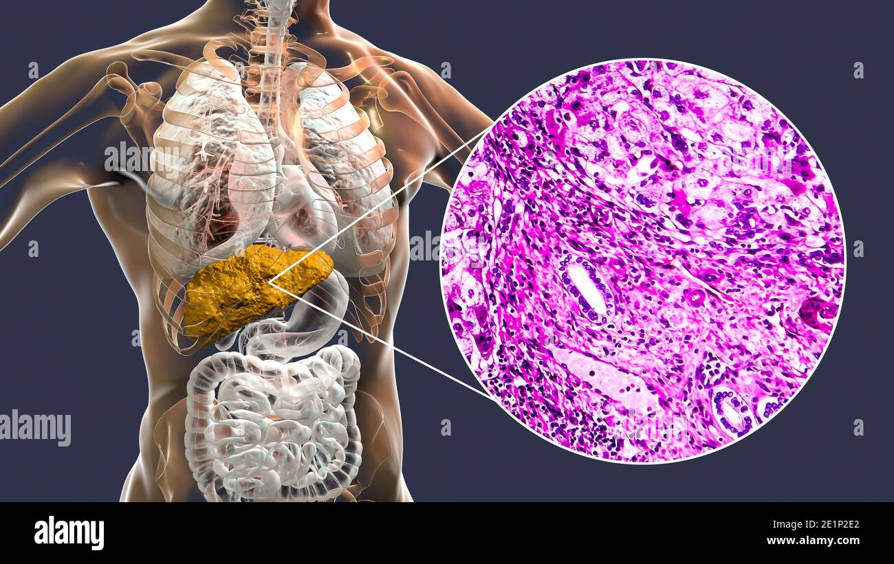 Liver cirrhosis, illustration and light micrograph Stock Photo Alamy