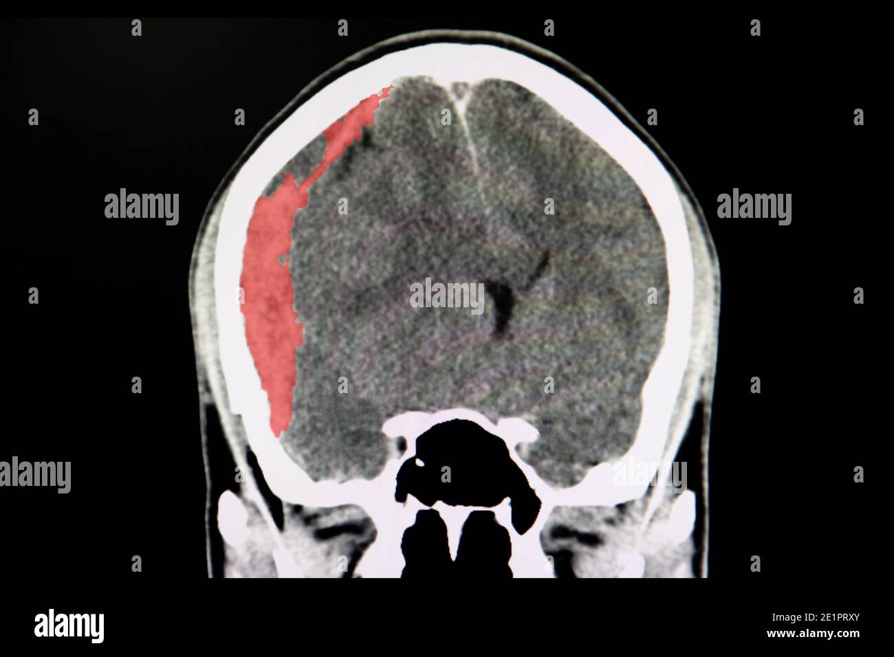 A CT scan of the brain of a patient with traffic accident showing acute subdural hematoma. Stock Photo