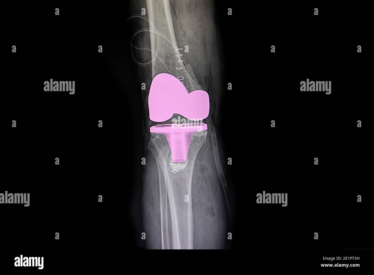 the xray film of a patient right knee after total knee arthroplasty operation. Stock Photo