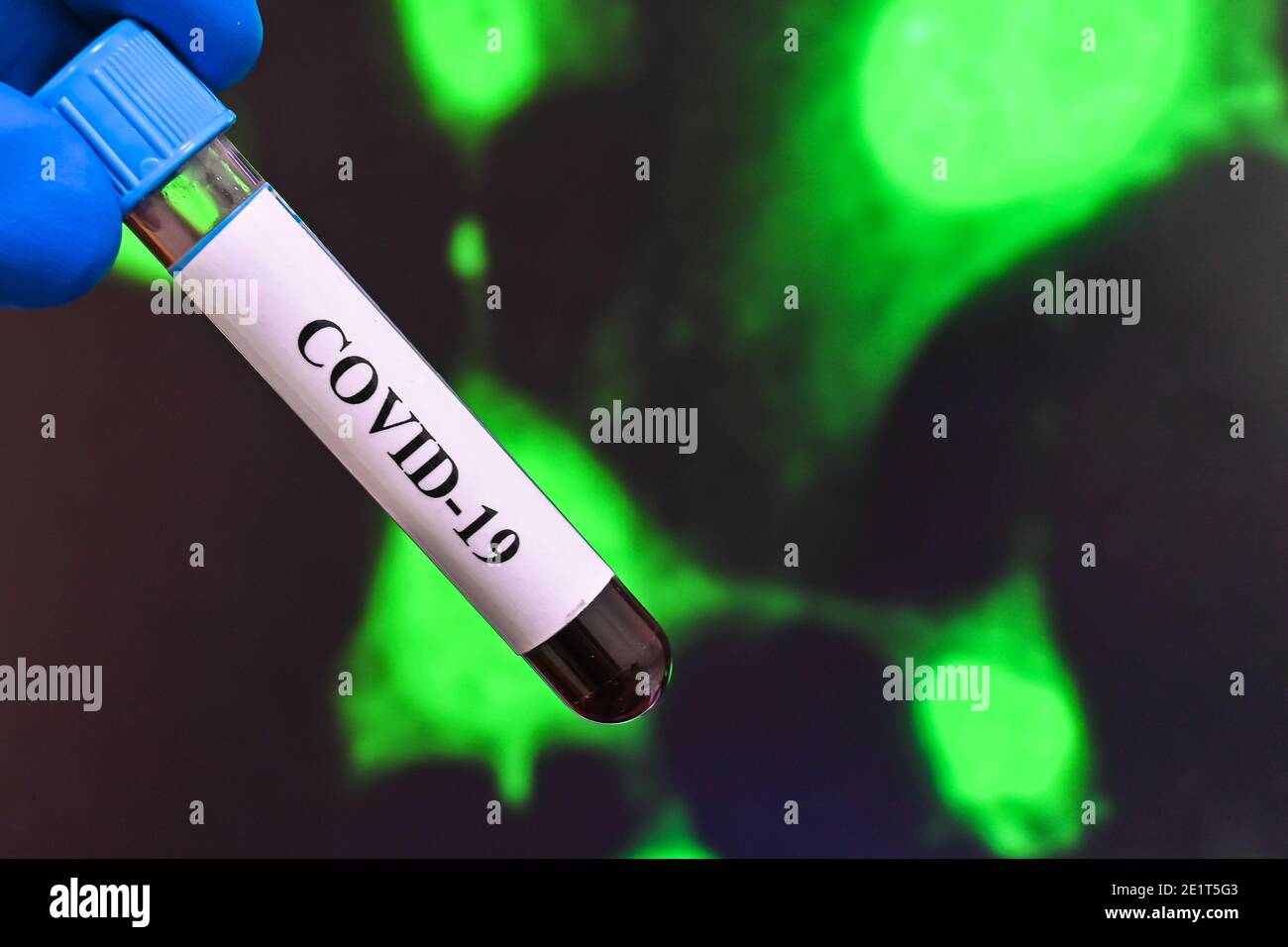 Coronavirus test. Detection of antibodies for COVID-19 in a blood sample. Stock Photo