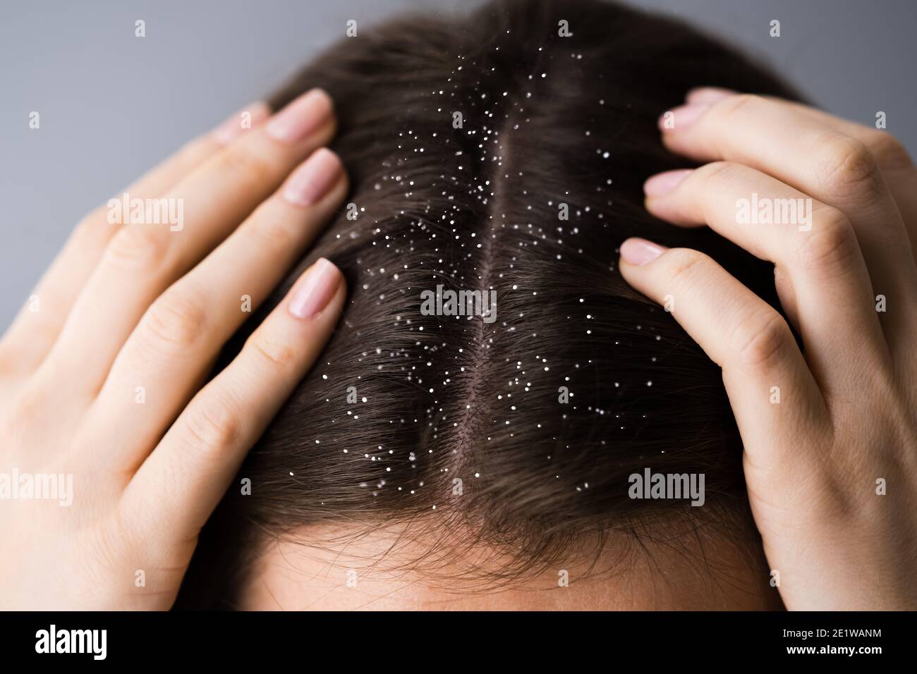 Itchy Head Scalp And Hair Dandruff Problem Stock Photo