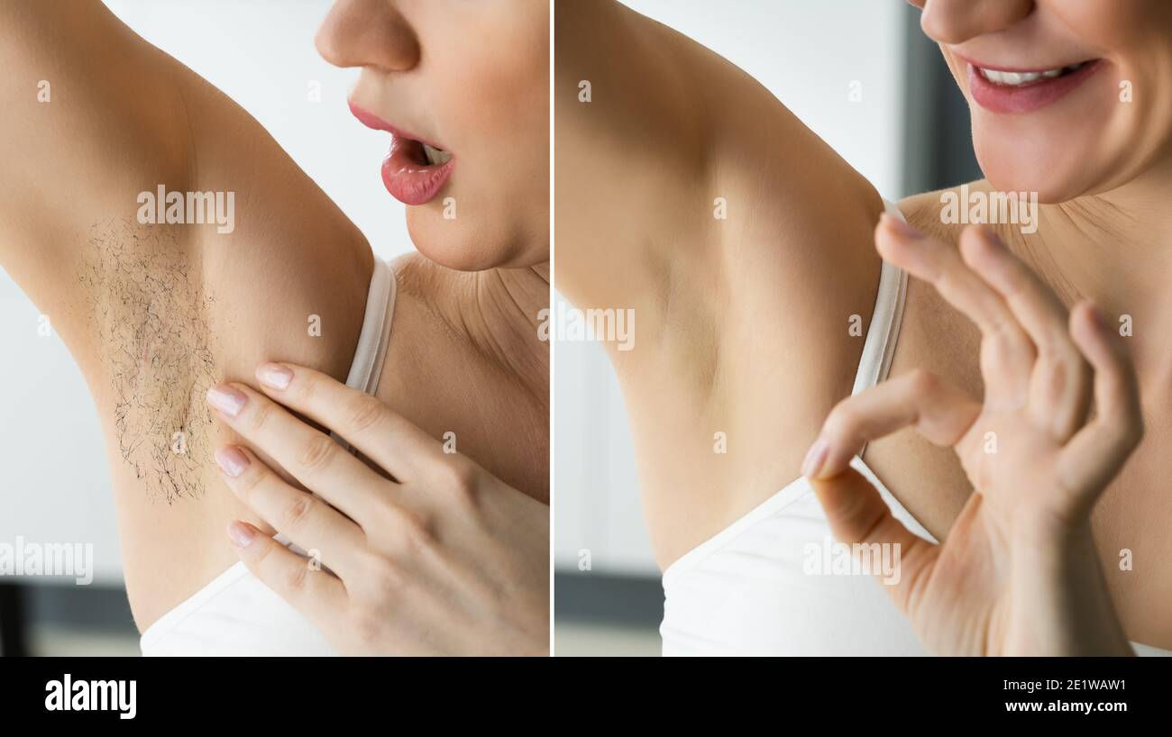 Laser Electrolysis IPL Hair Removal Before And After Stock Photo