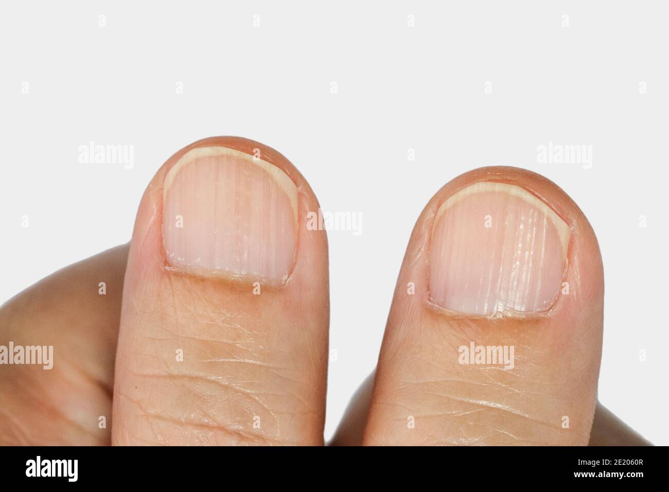 Melanonychia causes and treatment - Nailner Nail Fungus Products