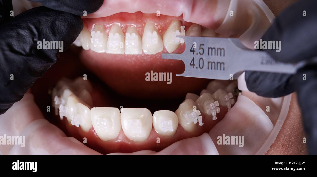 Horizontal close-up snapshot of dentist's hands measuring distance from a bracket to tip of tooth. Dental height gauge. Top view. Concept of stomatology and orthodontic treatment. Stock Photo
