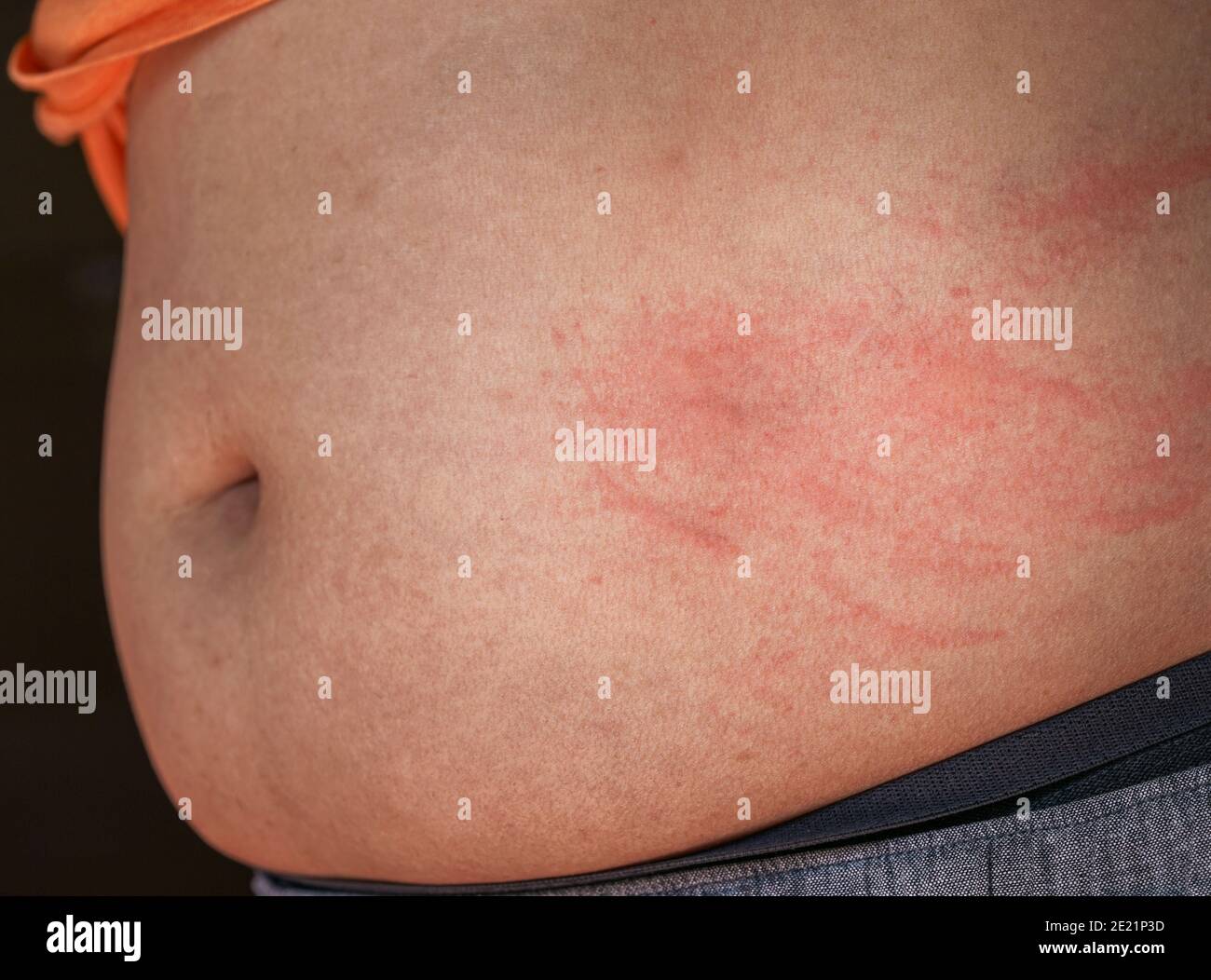 Close up itchy body rash caused by allergies on middle part of man body. Scratch marks on the skin. Stock Photo