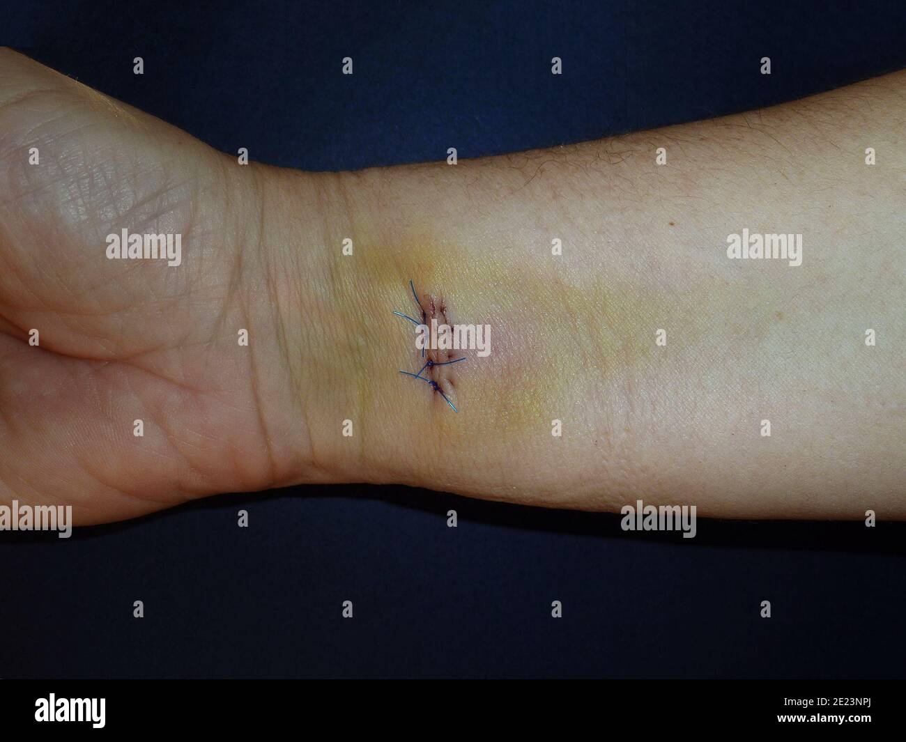 Closeup shot of severe scars on the hand after surgery Stock Photo Alamy