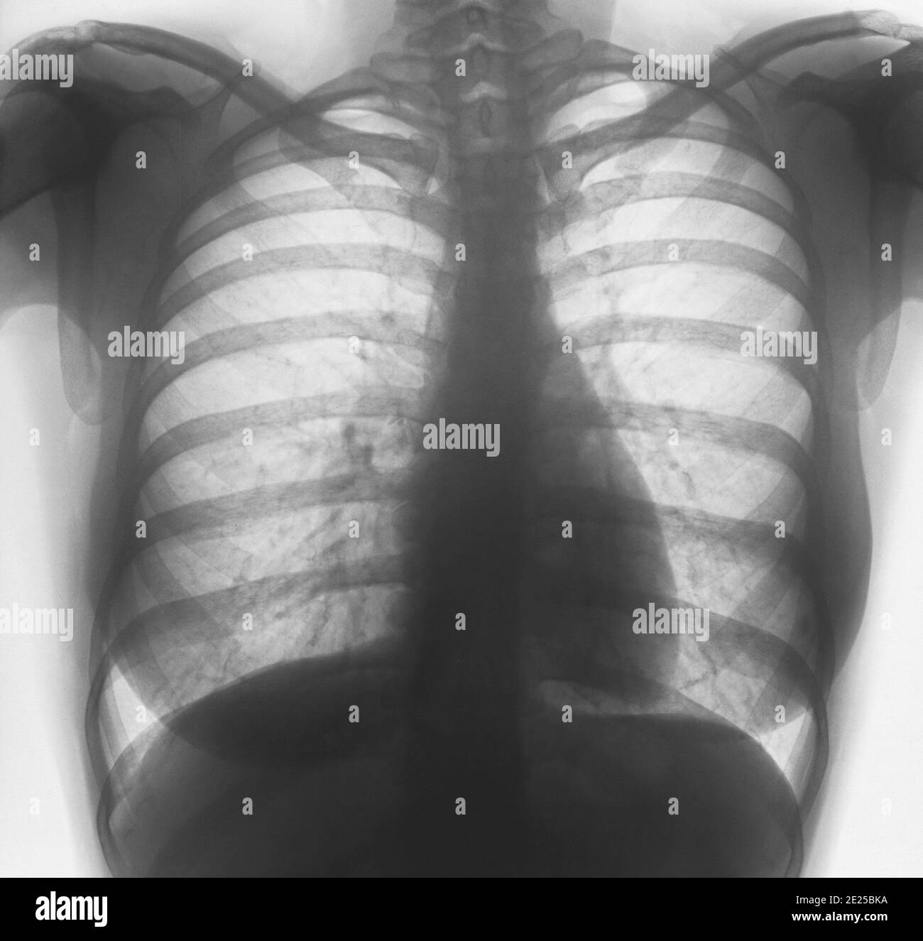 Chest X-ray or X-Ray Image Of human Chest. Invert color style . Stock Photo