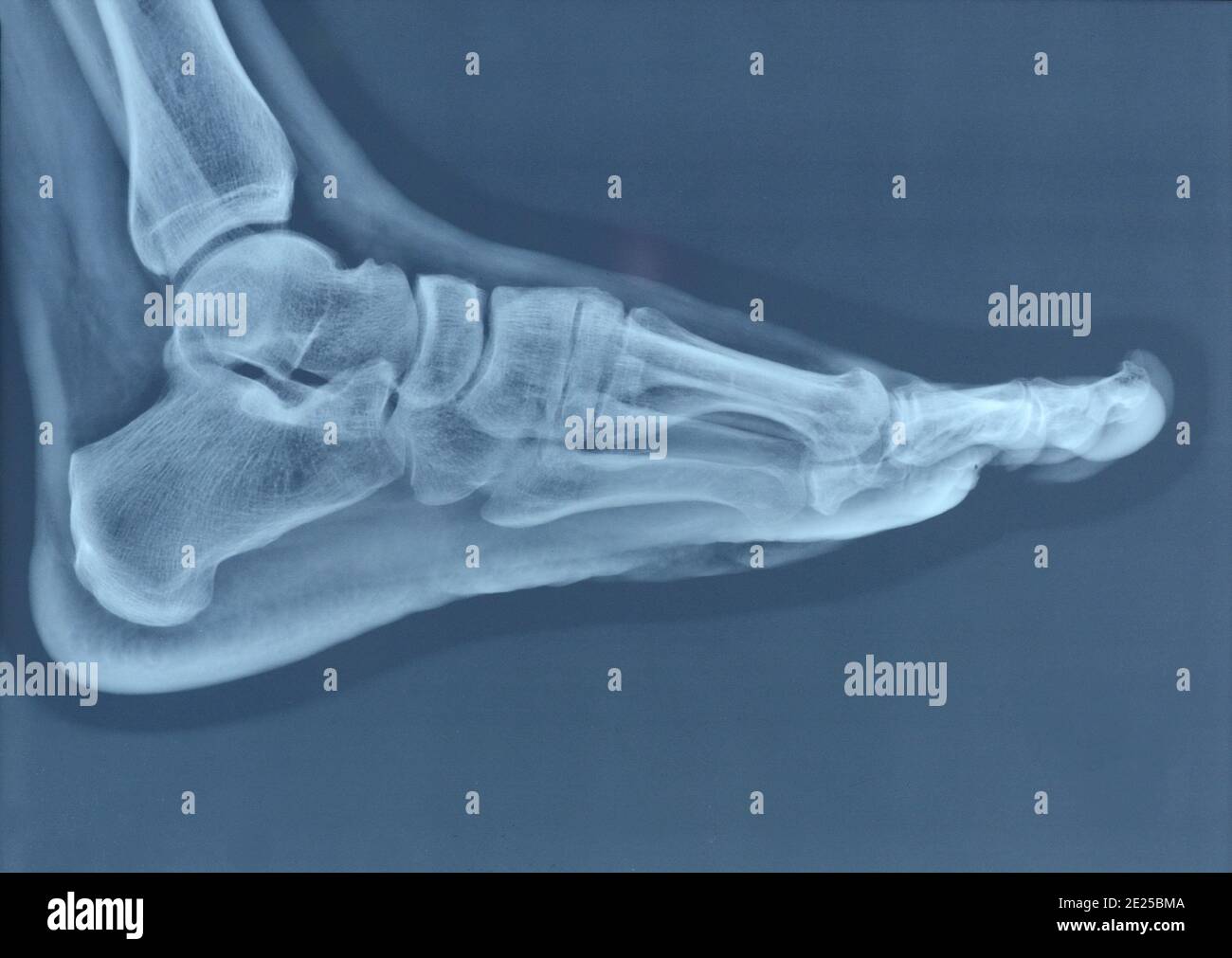 X-ray normal human foot . Stock Photo