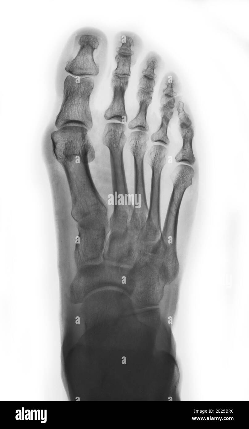 X-ray normal human foot . Invert color style . Stock Photo