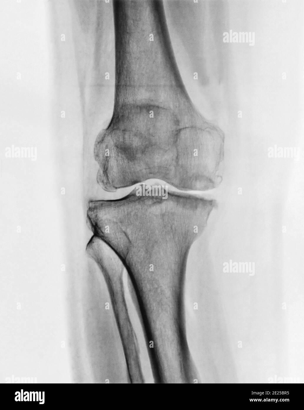 X-ray image of a knee. Invert color style . Stock Photo