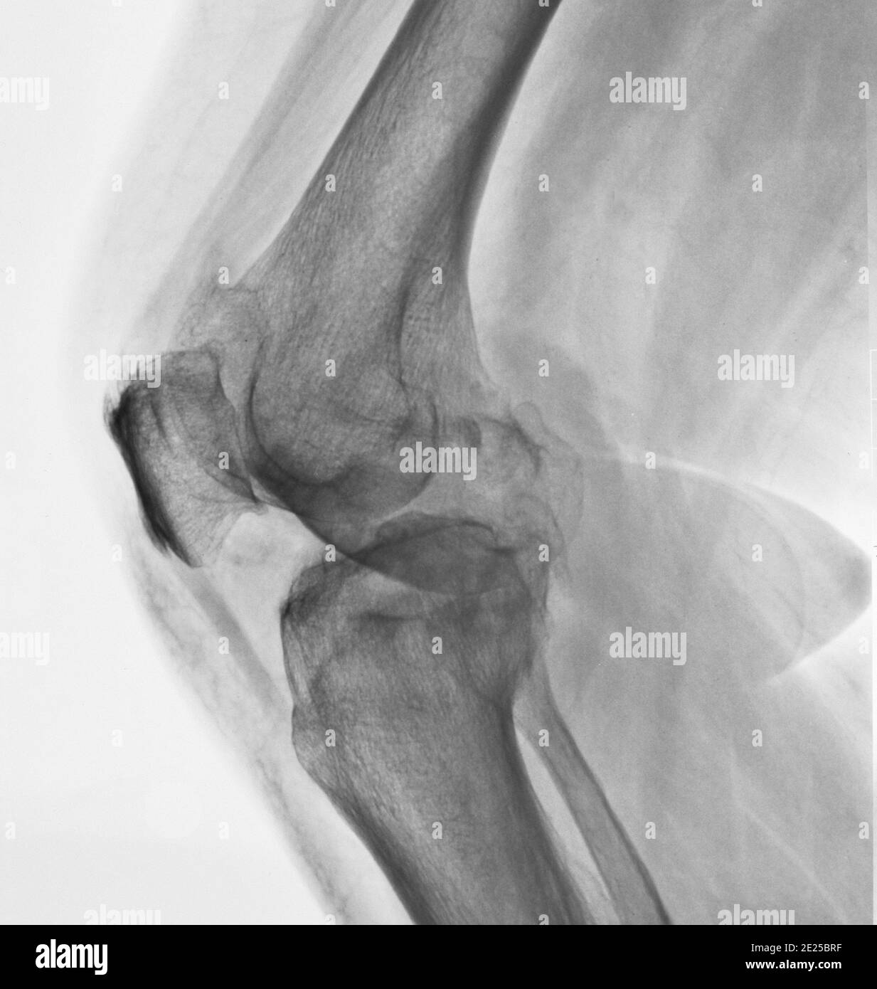 X-ray image of a knee. Invert color style . Stock Photo