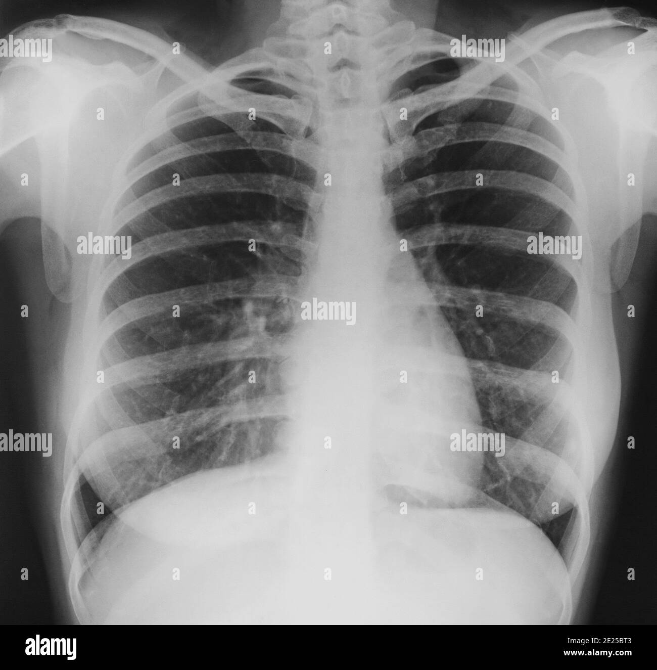 Chest X-ray or X-Ray Image Of human Chest Stock Photo