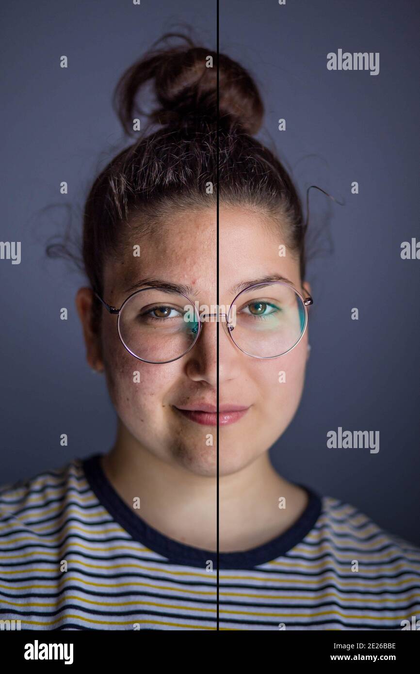 Cute girl with eyeglasses and with facial skin problems. Before and after medical treatment Stock Photo