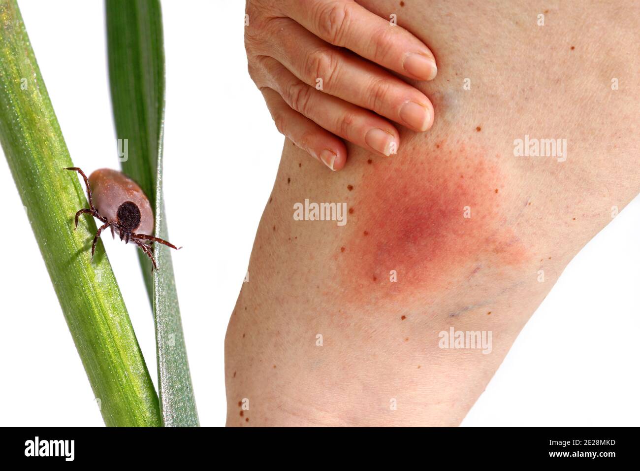 Blush of a tick-borne Lyme borreliosis disease on a woman's leg. Skin redness on the leg due to an allergy Stock Photo