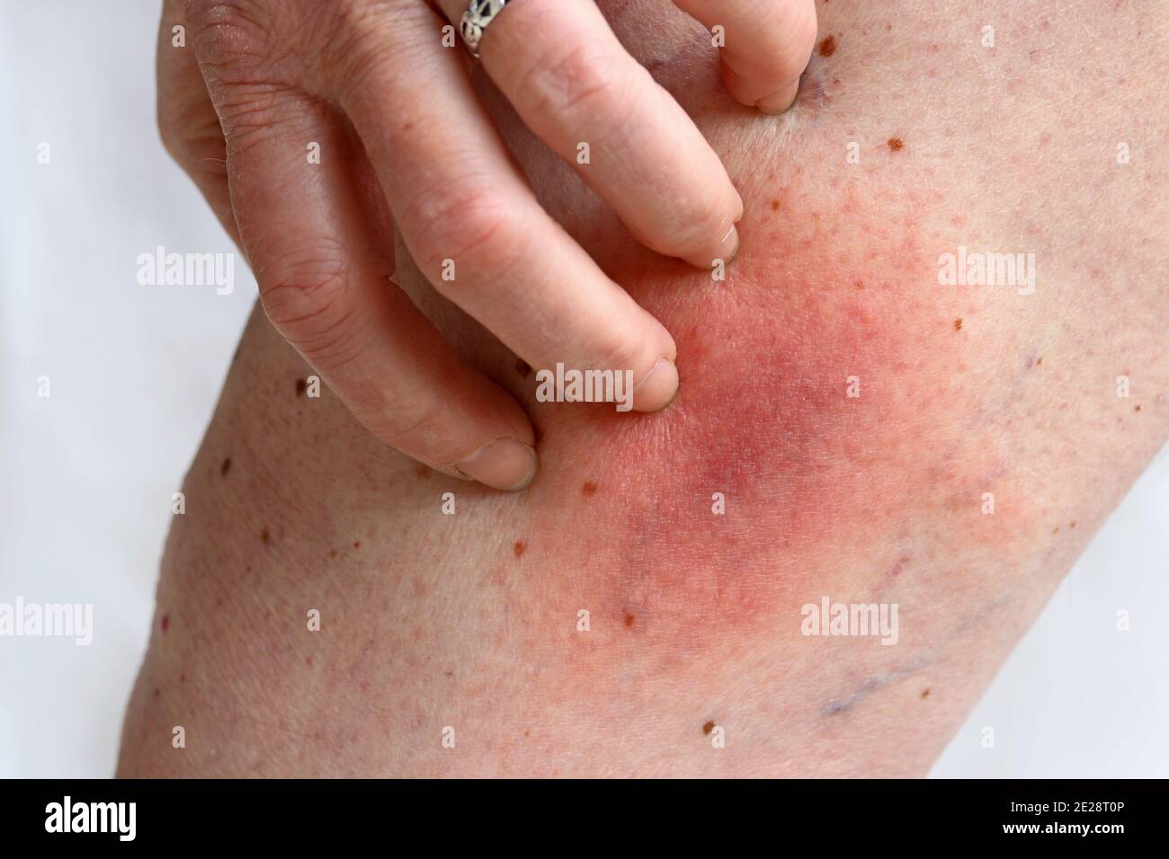 Blush of a tick-borne Lyme borreliosis disease on a woman's leg. Skin redness on the leg due to an allergy Stock Photo