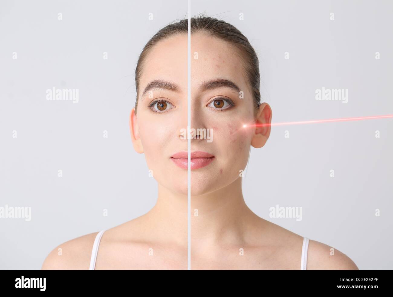 Young woman before and after procedure of acne removal by laser on