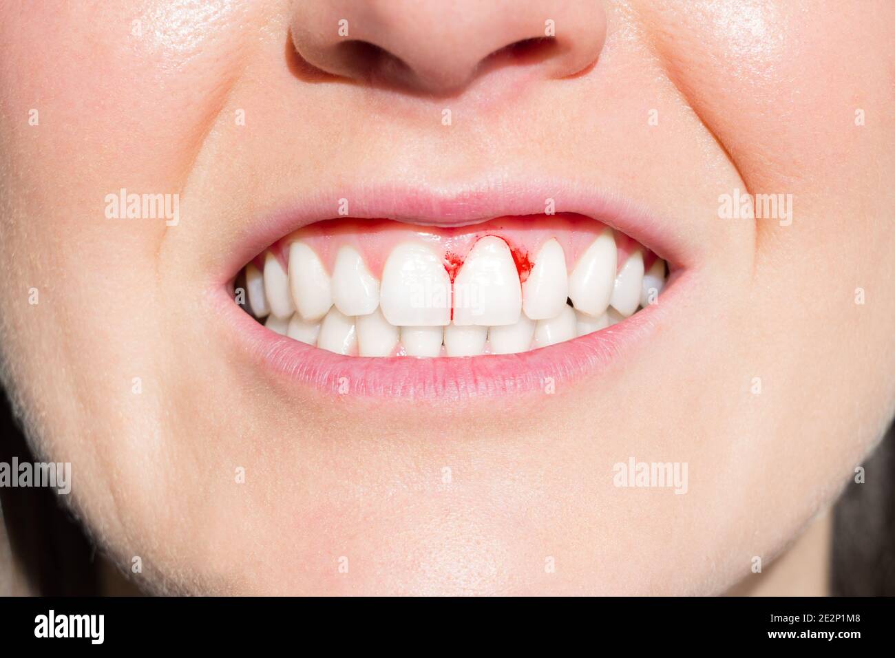 Bleeding mouth hires stock photography and images Alamy
