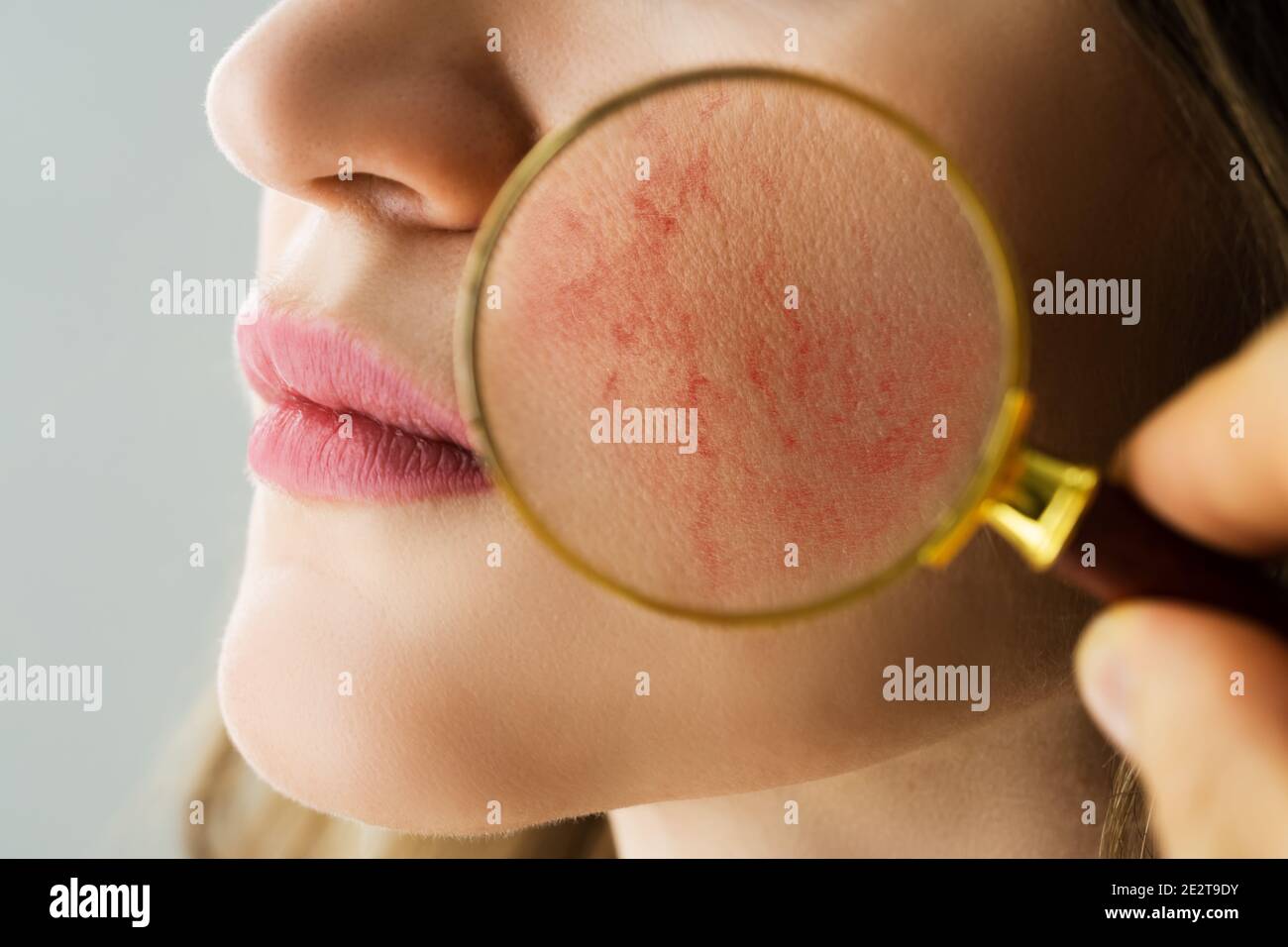 Rosacea Face Skin Problem And Aesthetic Treatment Stock Photo