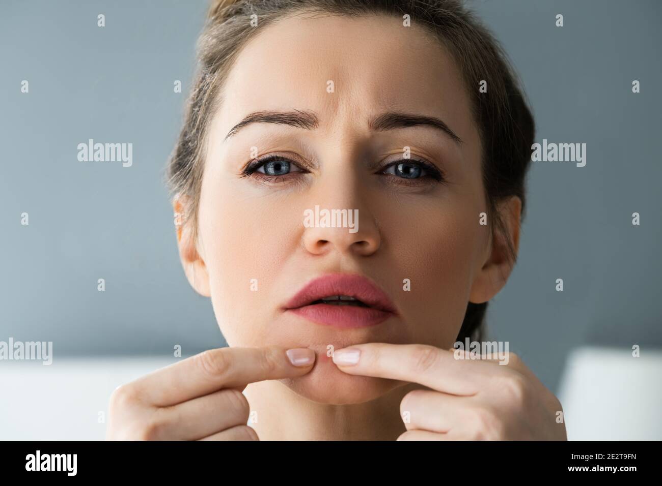 Woman Cheek At Pimple Dermatology Skin Problem Stock Photo
