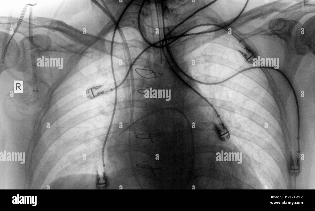 Xray film of patient after surgery Stock Photo Alamy