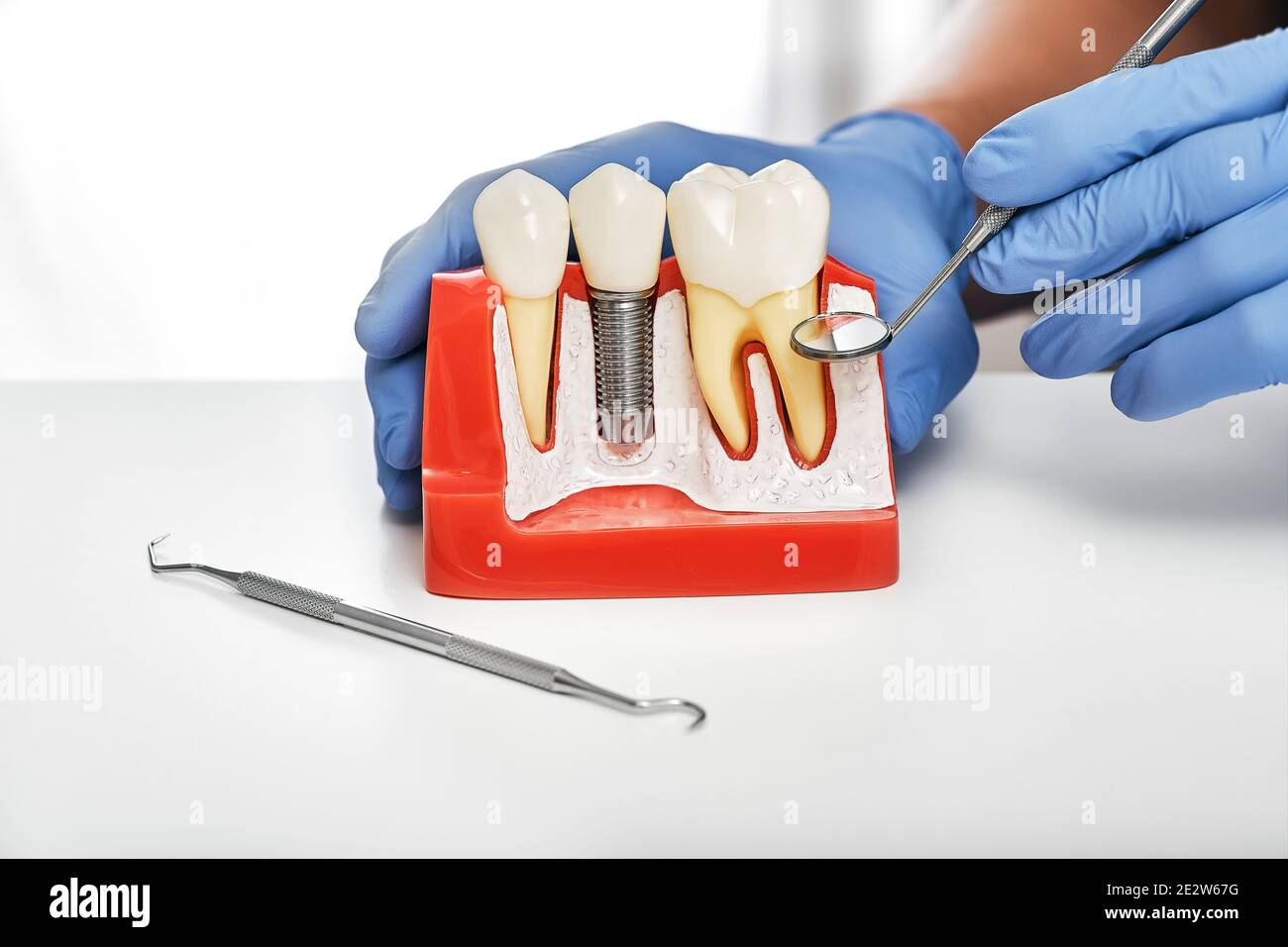 Dental prosthetics concept. Showing the installation of a dental