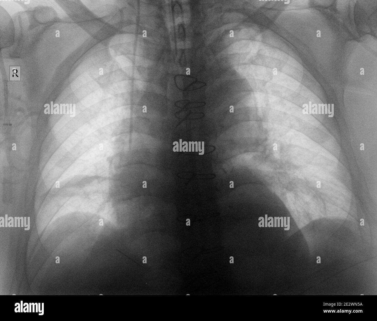 Plain chest radiagraph of patient after cardiac surgery. Stock Photo