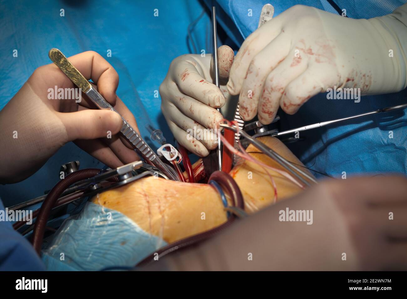 Working surgeons during surgical procedure. Stock Photo