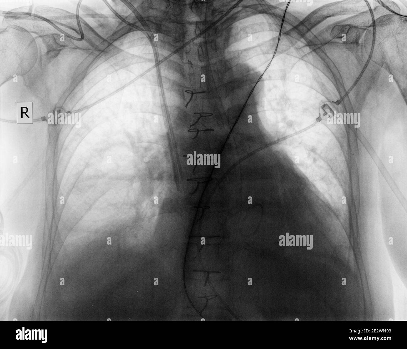 Plain chest radiograph of patient after surgery. Stock Photo