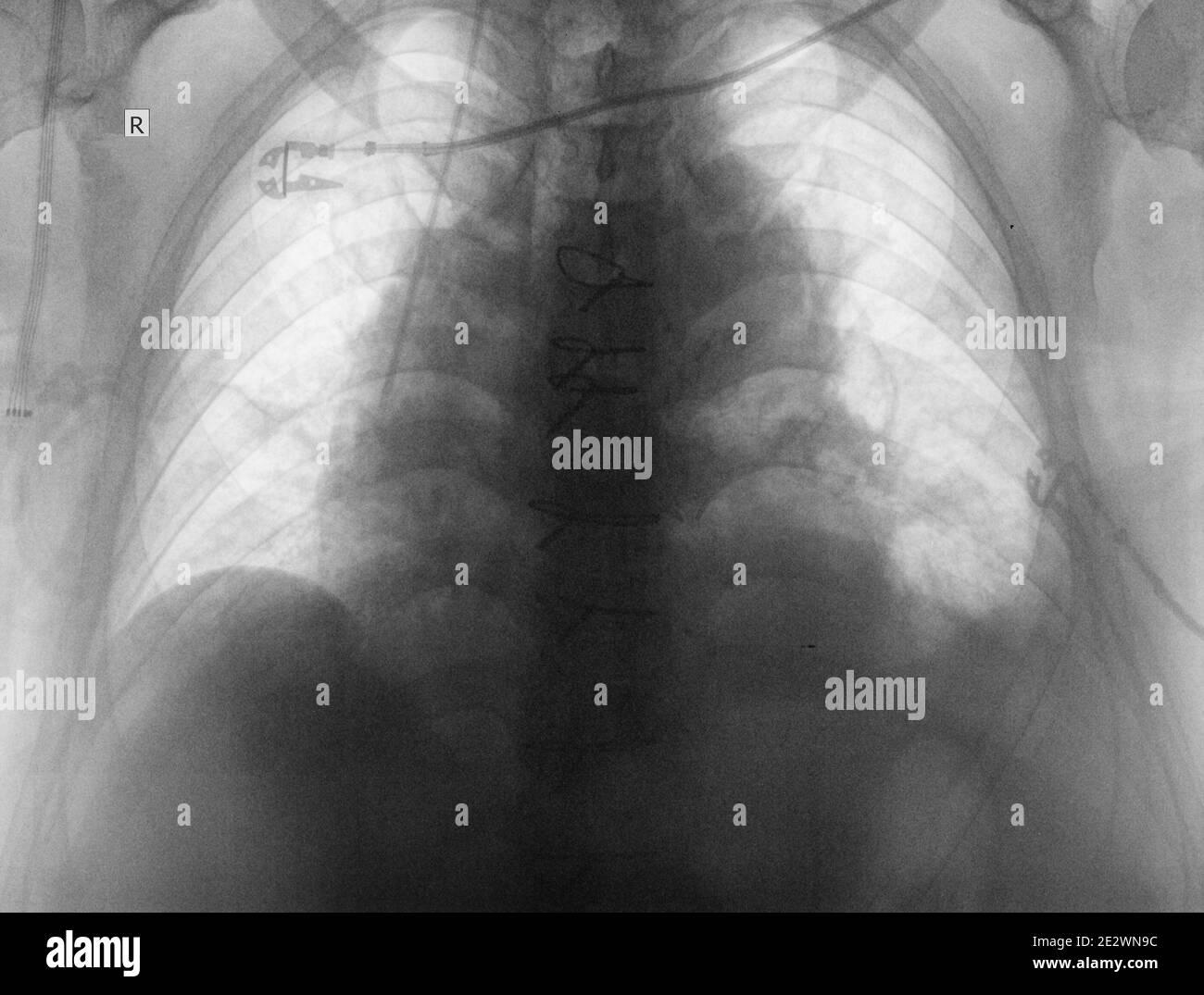 Radiograph of thoracic cavity organs. Stock Photo