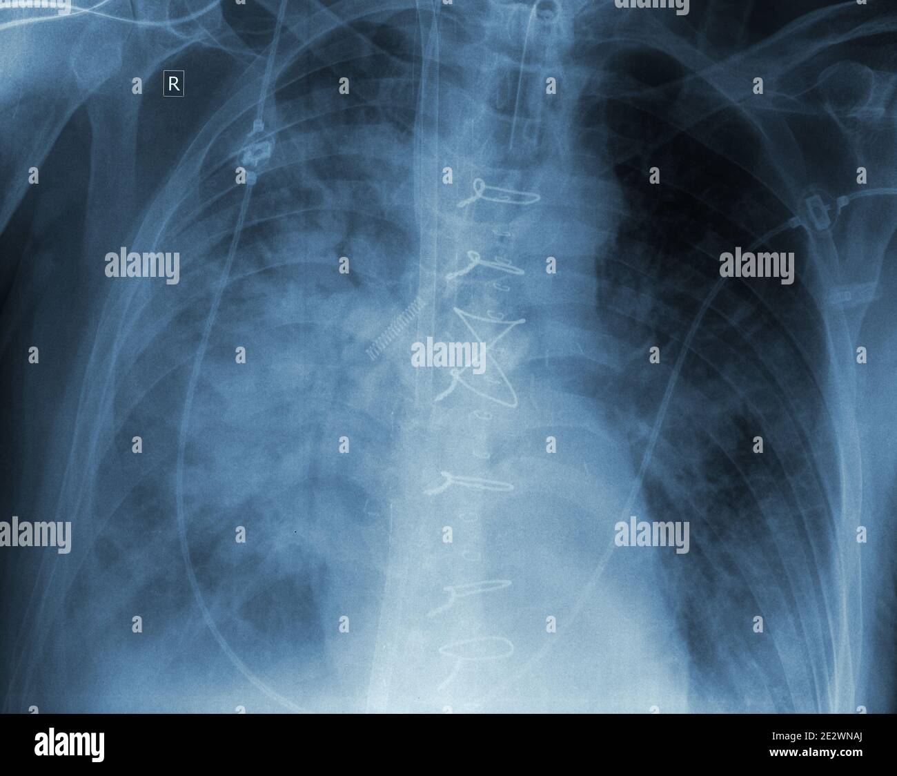 X-ray film of patient with complication after surgery. Stock Photo