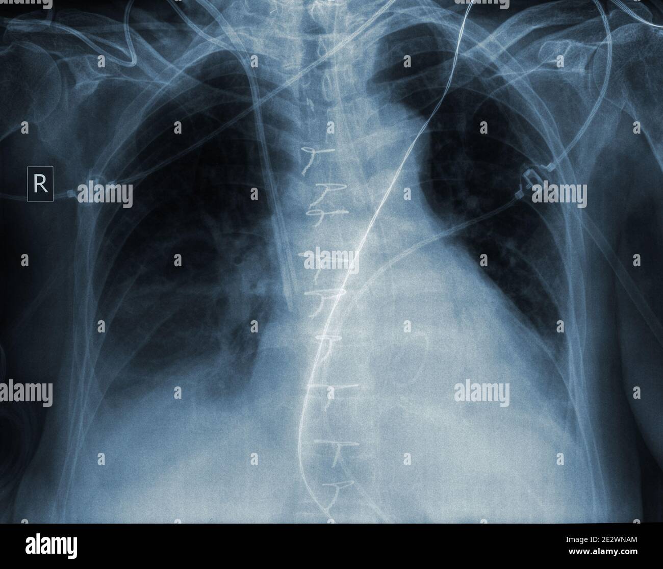 X-ray image of human ribcage. Stock Photo