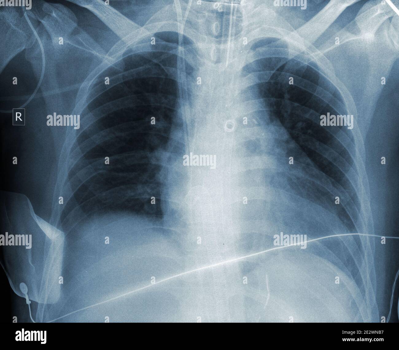 Radiogram result of patient chest. Stock Photo
