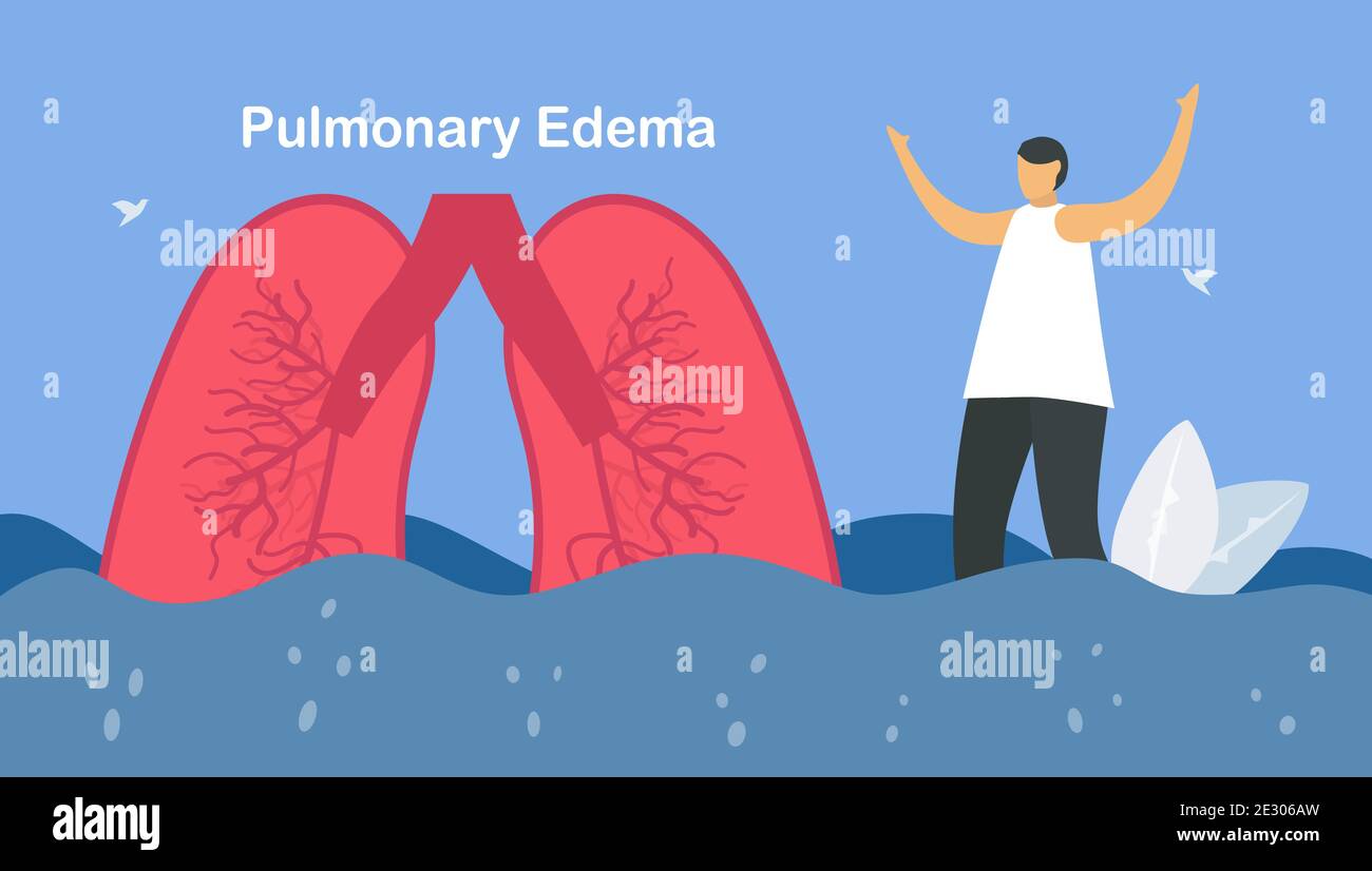 Pulmonary Edema Is Symptom That Lungs Fill With Fluid Other Names Is Lung Congestion Lung Water And Pulmonary Congestion Body Struggles To Get En Stock Vector Image Art Alamy