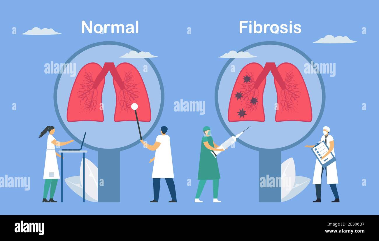 Pulmonary fibrosis is a part of restrictive lung disease. Lung tissue damaged and