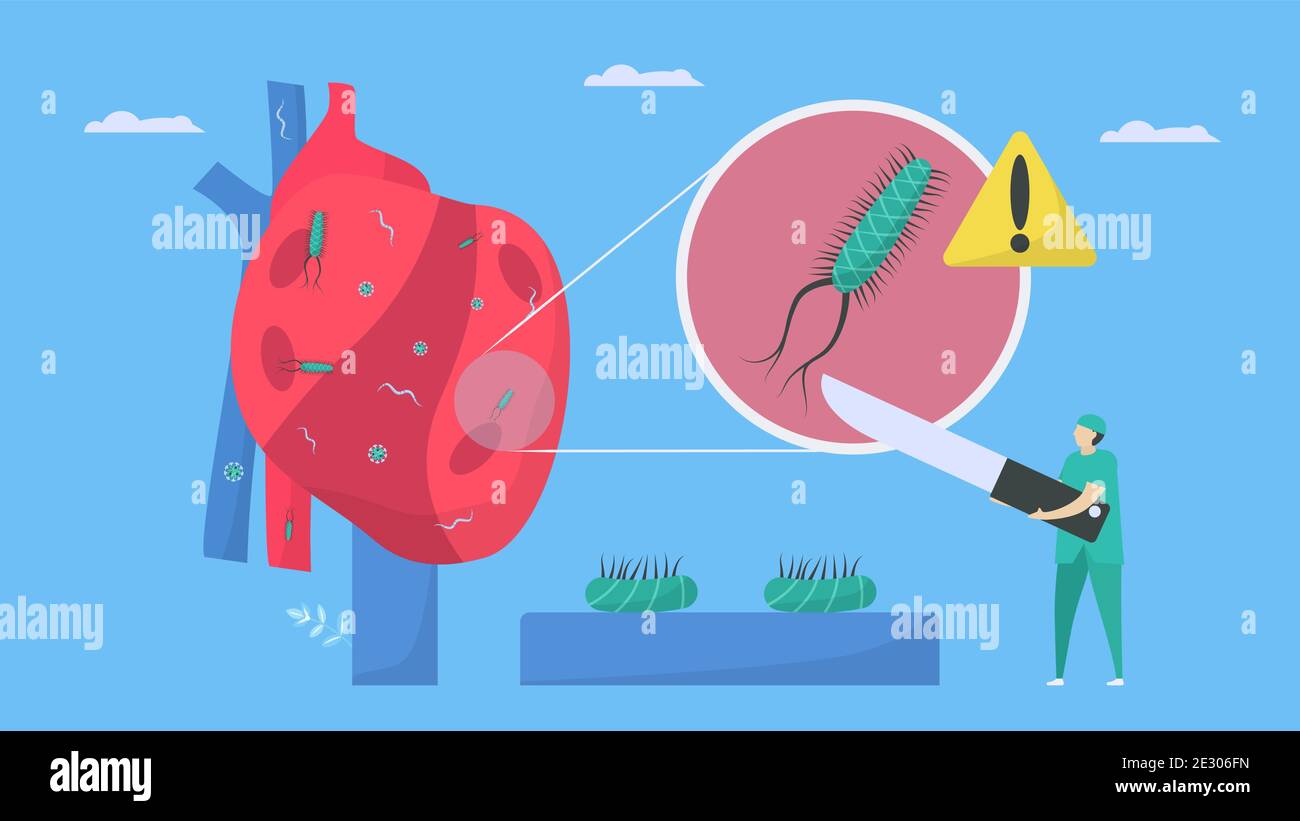 Cardiology treatment by surgeon. This disease calls endocarditis. It is
